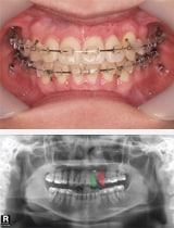 picture4 orthodontic_process4