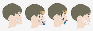 주걱턱 교정