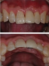 앞니 상방의 잇몸뼈의 볼륨이 자연치아와 유사하게 회복되어진 모습