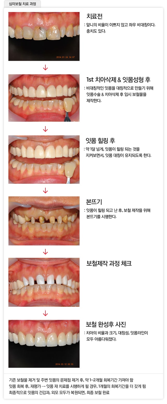 하함동치과에서 성형복원으로 자신감 되찾으세요